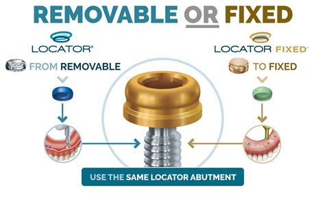 zest metal housing attachments denture|zest dental implants.